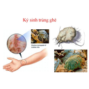 cái ghẻ và bệnh ghẻ